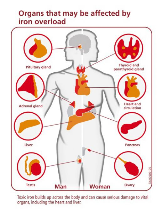 Organs affected by iron overload